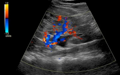 سونوگرافی کلیه در چه مواردی کاربرد دارد؟
