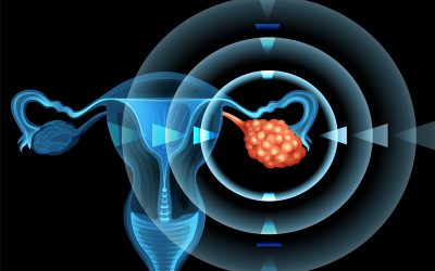 تشخیص کیست تخمدان