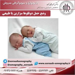 وضع حمل دوقلوها سزارین یا طبیعی