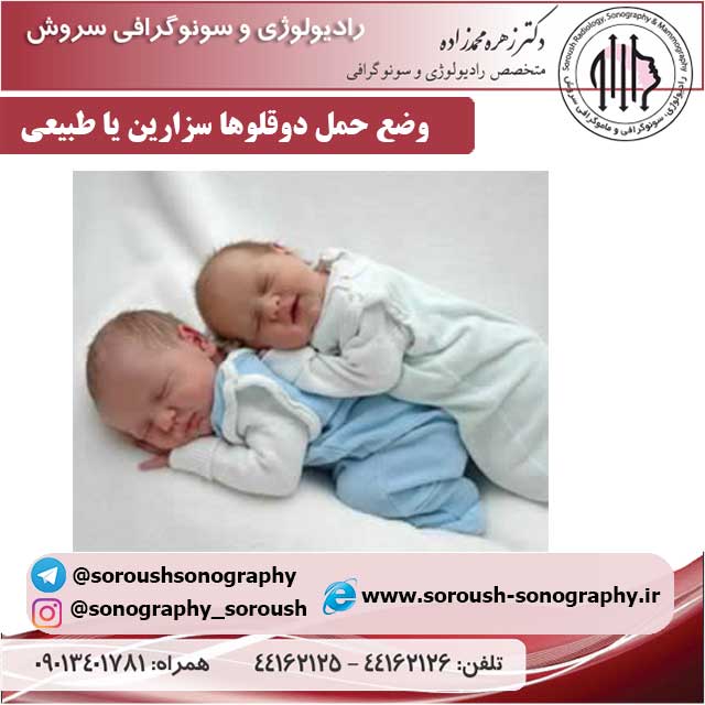 وضع حمل دوقلوها سزارین یا طبیعی