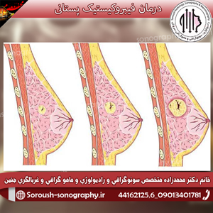 درمان فیبروکیستیک پستان