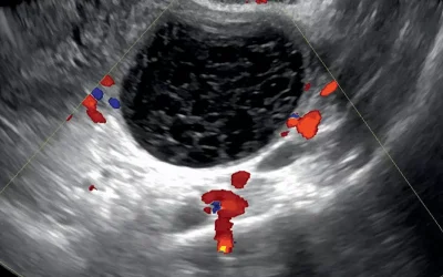 خونریزی کیست تخمدان و تشخیص آن با سونوگرافی