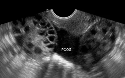 تخمدان پلی کیستیک