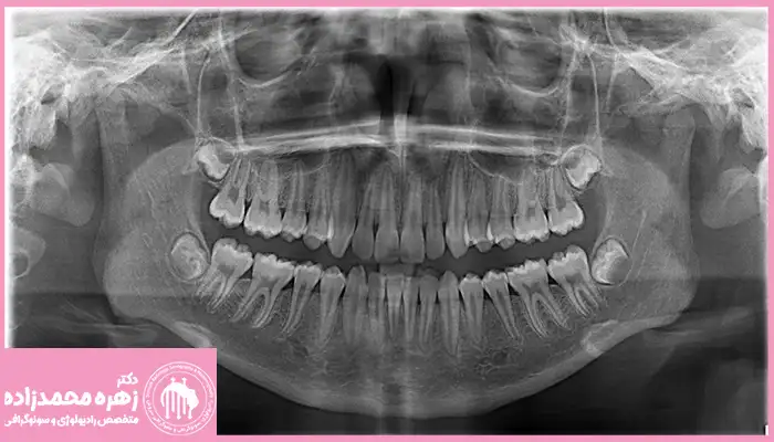 سونوگرافی-پانورکس