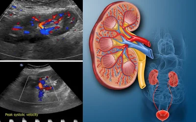 سونوگرافی کالر داپلر کلیه: سونوگرافی عروق کلیه