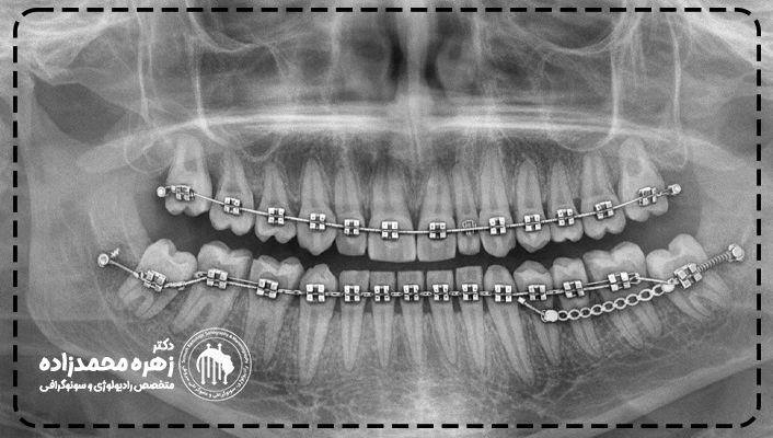 او پی جی دندان